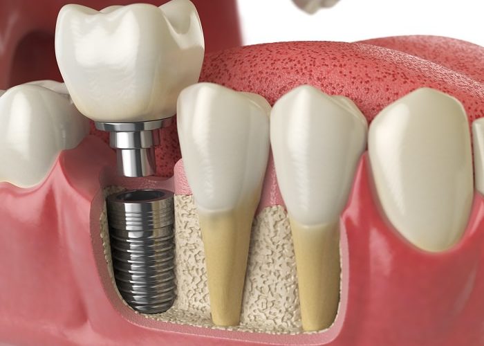 implante dental