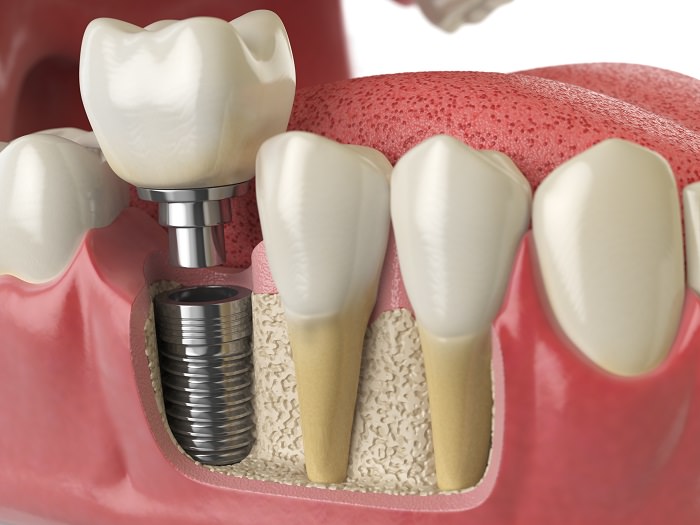 implante dental
